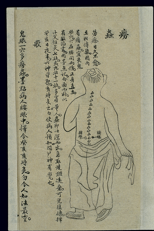 Historic Chinese moxibustion woodcut; Wellcome Collection